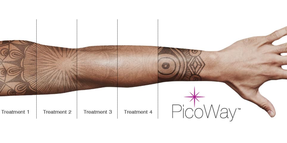 picoway pigmentation removal sydney