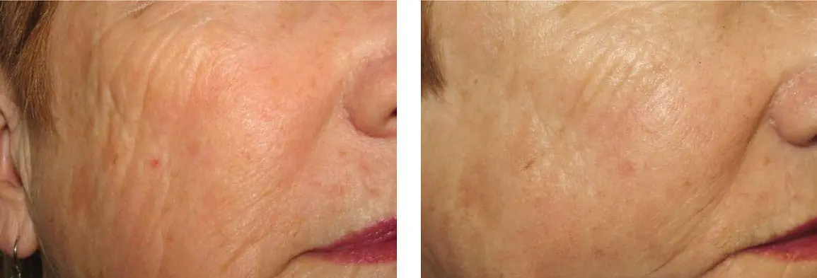 picosure laser pigmentation sydney