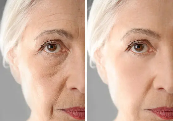 anti-wrinkle injections