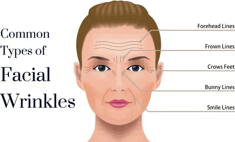 anti-wrinkle injections