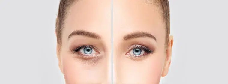 blepharoplasty upper blepharoplasty sydney