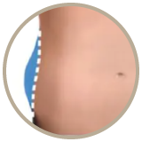 coolsculpting end result