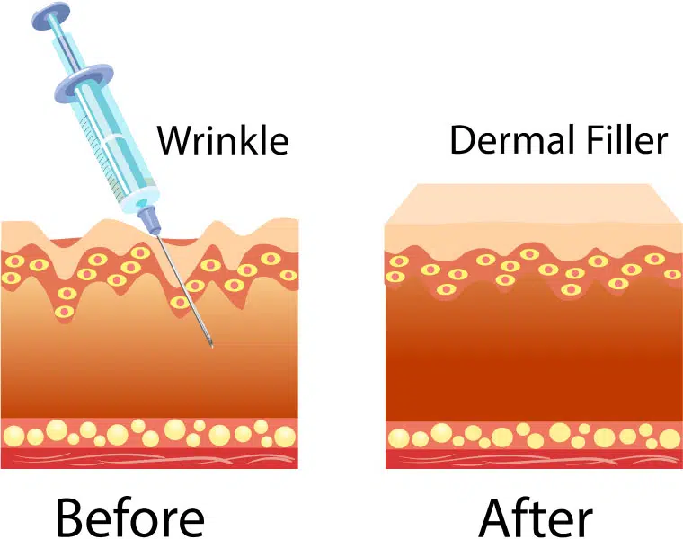 dermal fillers