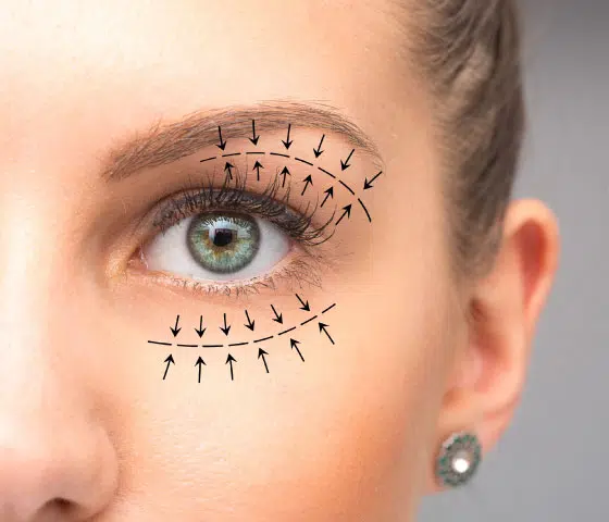 minimally invasive blepharoplasty blepharoplasty before and after
