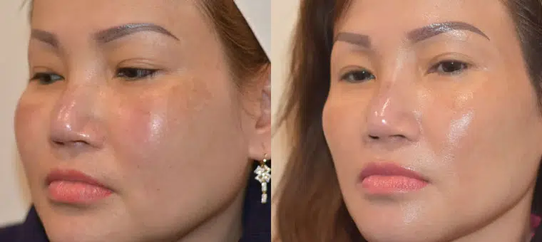 picoway-2 picoway laser treatment