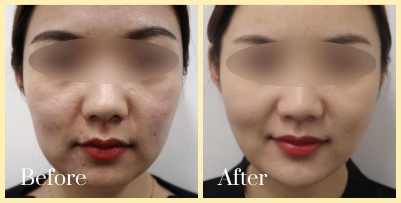 thread-lift-ba-7 jawline thread lift