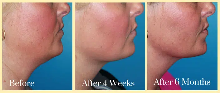 case study facetite case study