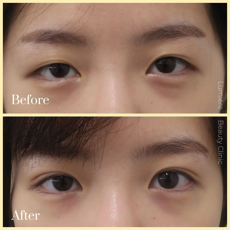 Eye Bag Removal Sydney Top Blepharoplasty & Eye Lift Surgeons