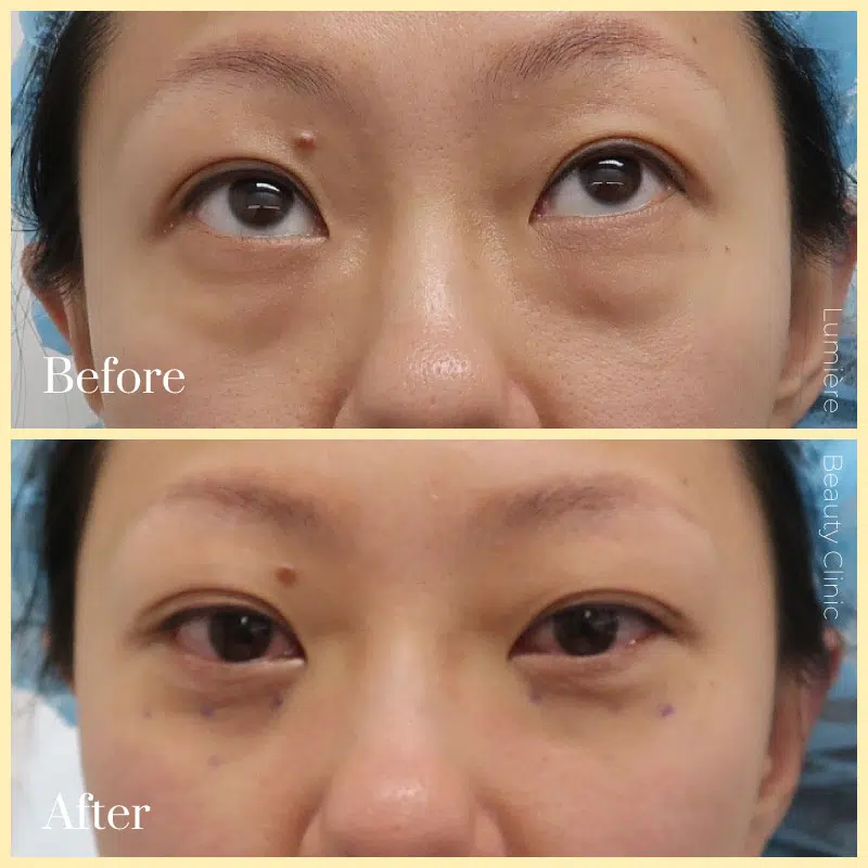 eye bag removal before after