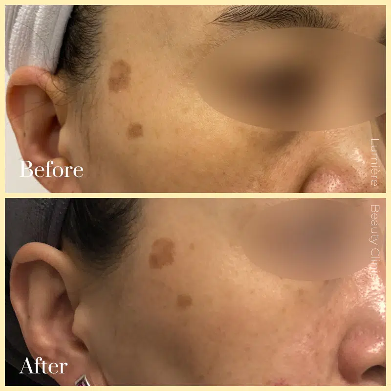 laser pigmentation removal before after