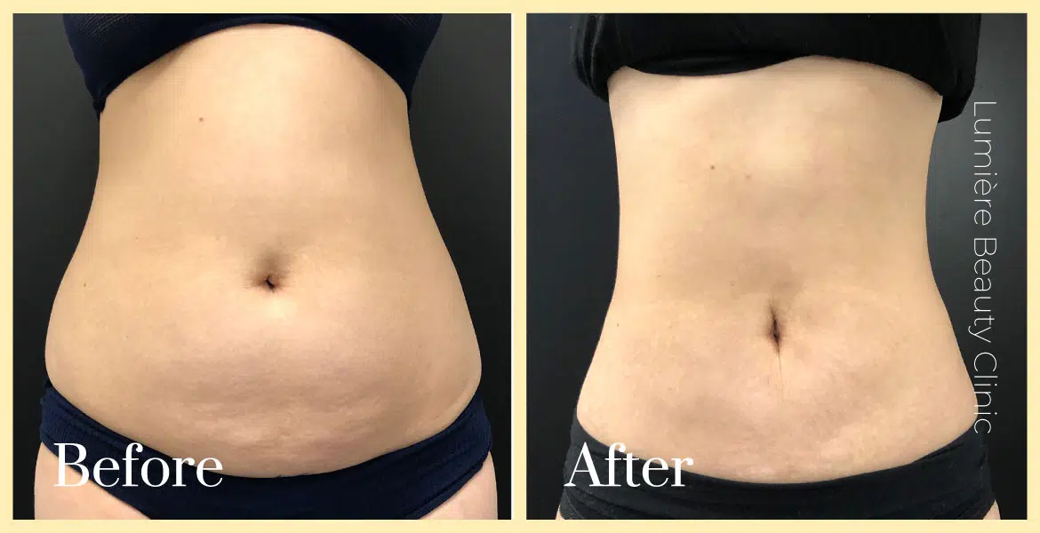 bodytite tummy fat reduction before after