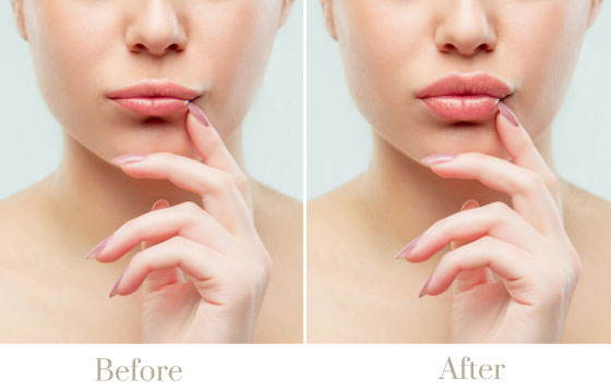 lip fillers injections lip fillers injections