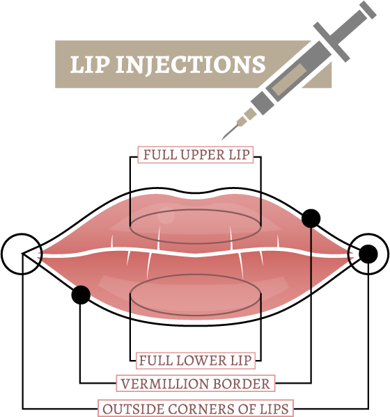lip injections sydney lip injections sydney