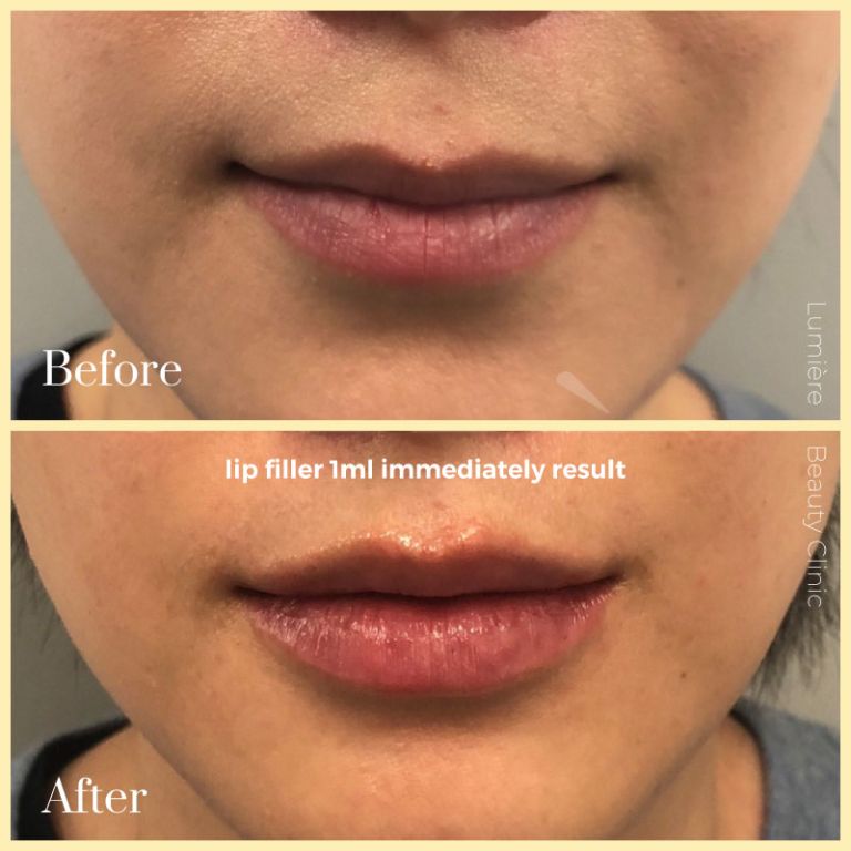 Voluptuous Lip Fillers Sydney Lumière Clinic