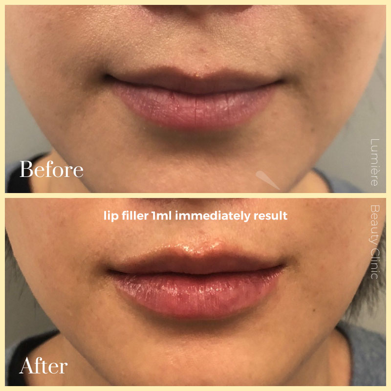 LIP INJECTIONS & FILLERS sydney