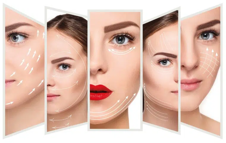 Brow Thread Lift 2 brow thread lift sydney