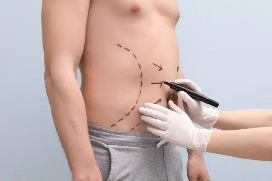 Doctor,Drawing,Lines,On,Man's,Stomach,With,Marker,Against,Light Liposuction for men sydney