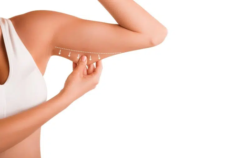 Arm Liposuction Arm Liposuction