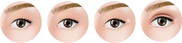 Asian Eyelid Surgery Asian Eyelid Surgery