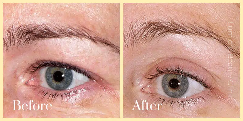 thermage flx before after