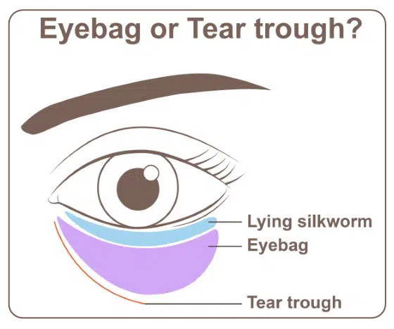 Tear Trough Under Eye Fillers