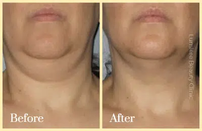 Ultherapy in sydney before and after