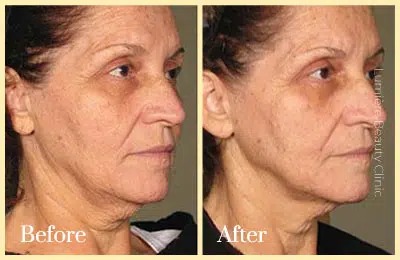 before and after ultherapy