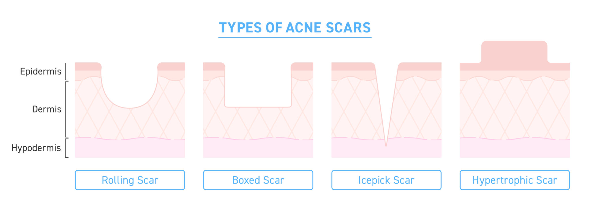 Illustration,Of,Types,Of,Acne,Scars What are the different types of acne scars?