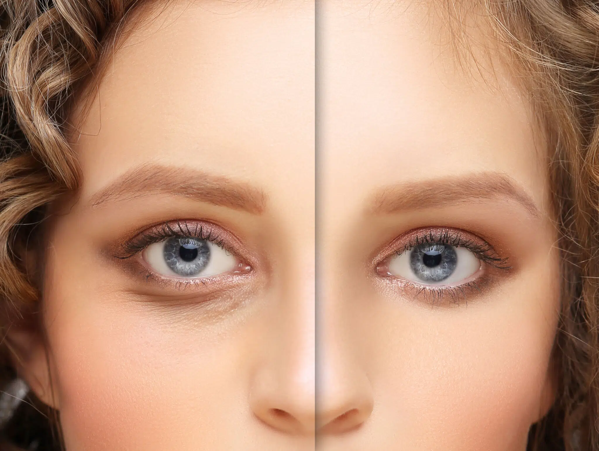 All Your Answers On How To Fix Sunken Eyes Lumière Clinic