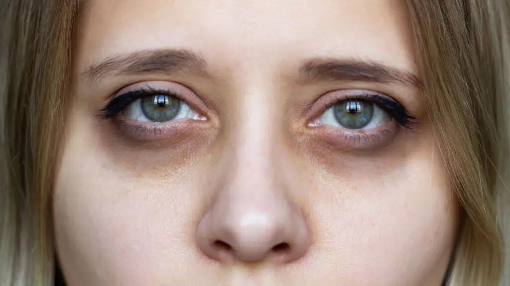 how to fix sunken eyes