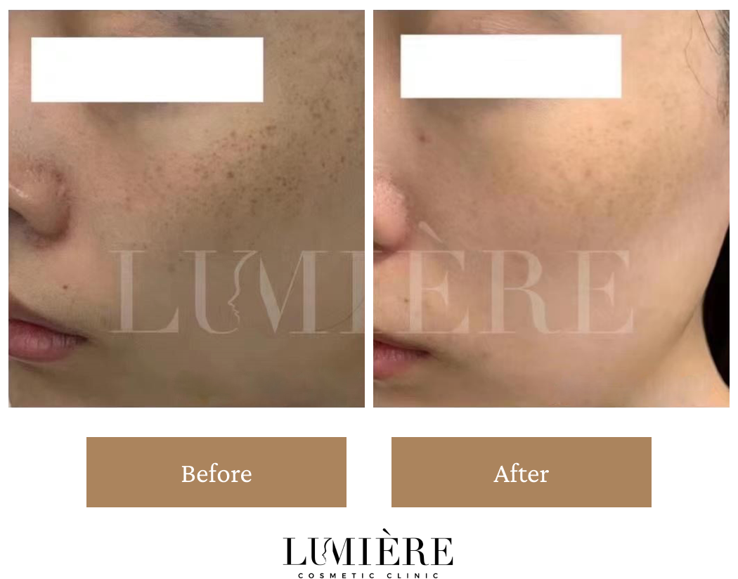 Expert Laser Pigmentation Removal in Sydney Lumière Clinic