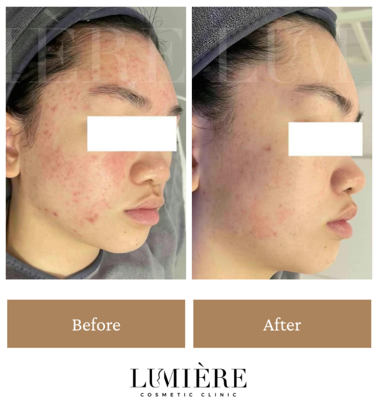 What Causes Acne And Effective Treatments Lumière Clinic