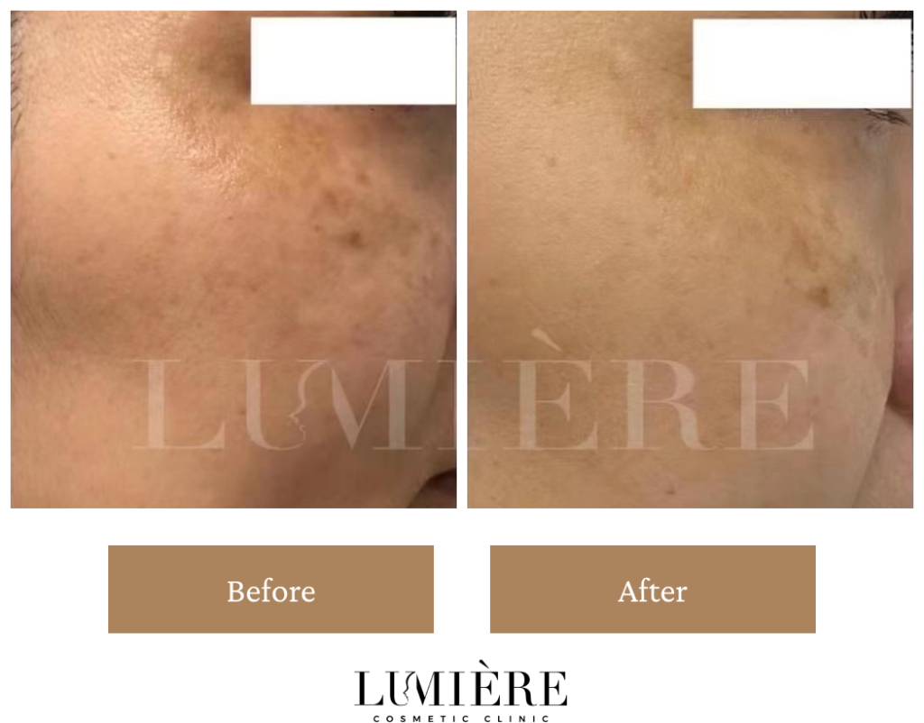 Expert Laser Pigmentation Removal