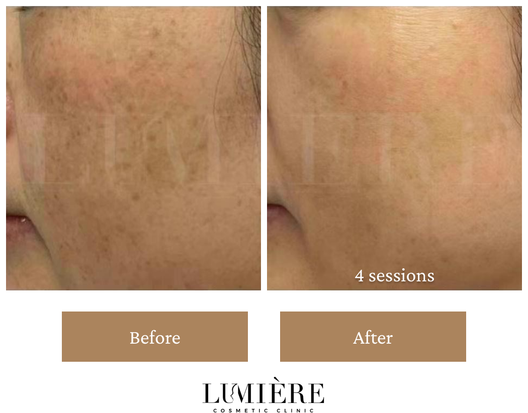 Expert Laser Pigmentation Removal in Sydney Lumière Clinic