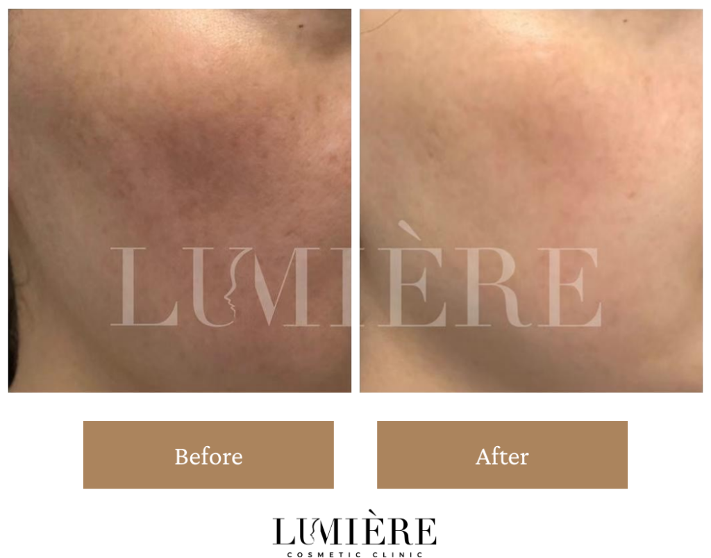 Expert Laser Pigmentation Removal