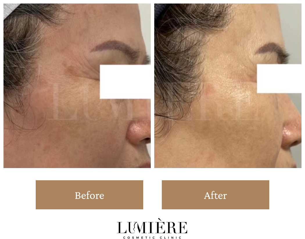 Expert Laser Pigmentation Removal in Sydney Lumière Clinic