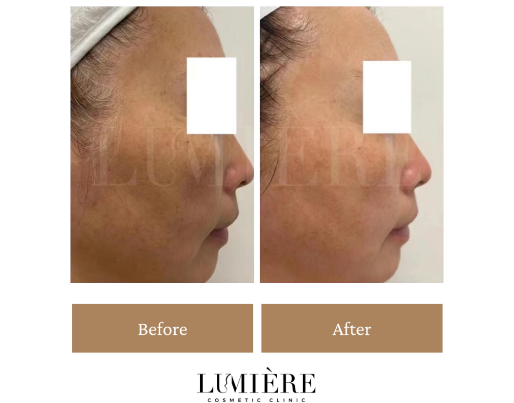 Expert Laser Pigmentation Removal