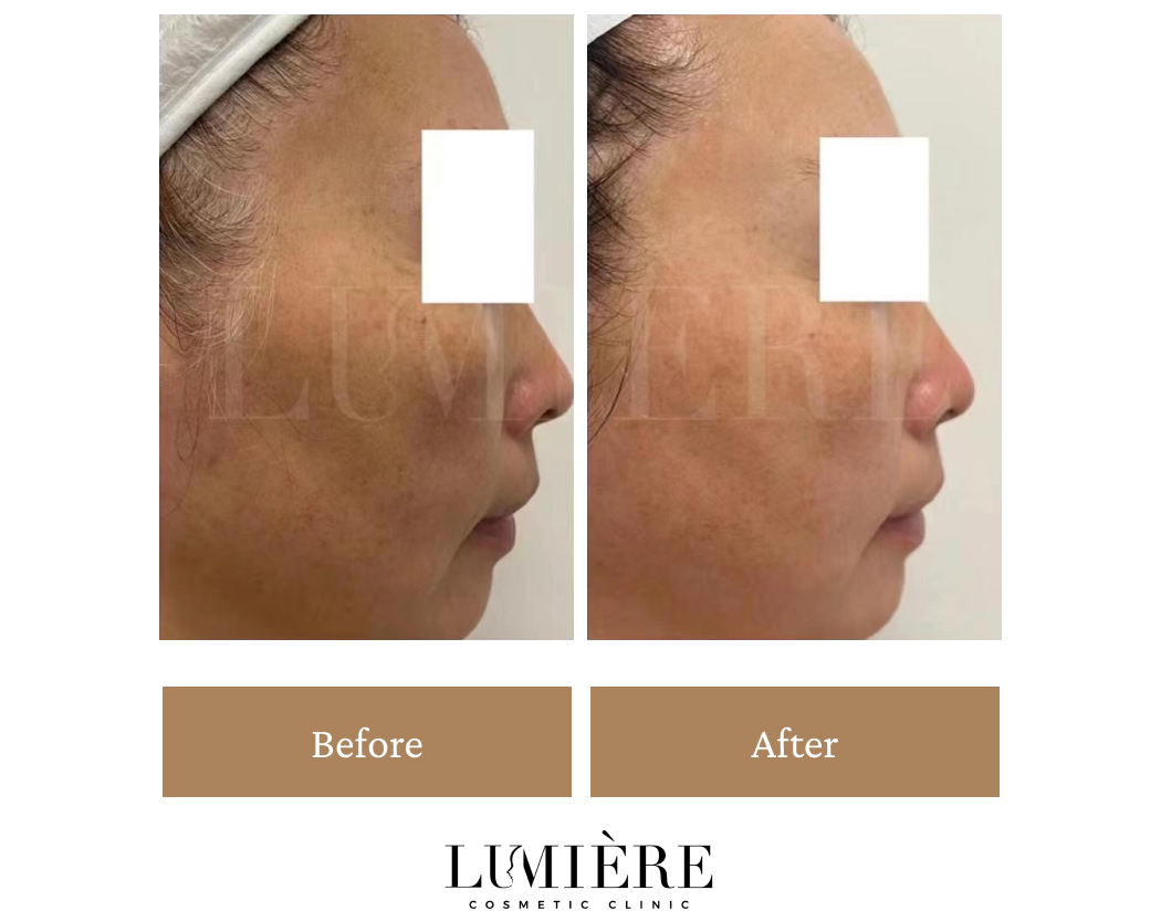 Expert Laser Pigmentation Removal in Sydney Lumière Clinic