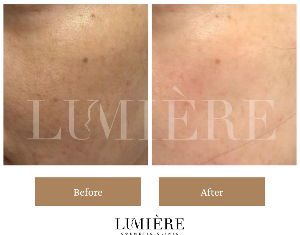 Expert Laser Pigmentation Removal