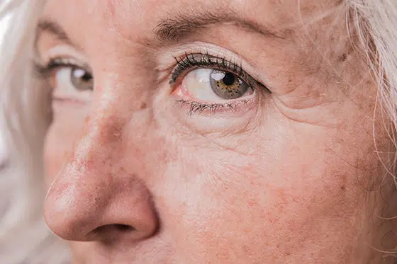 Laser treatment for age spots Laser treatment for age spots