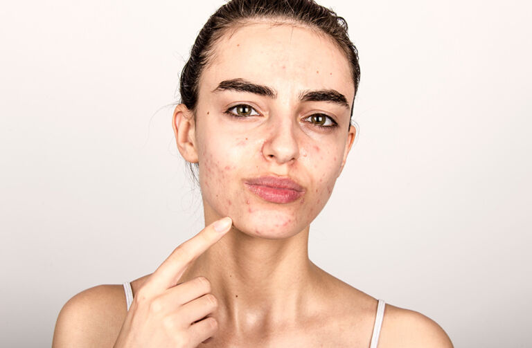 different types of acne