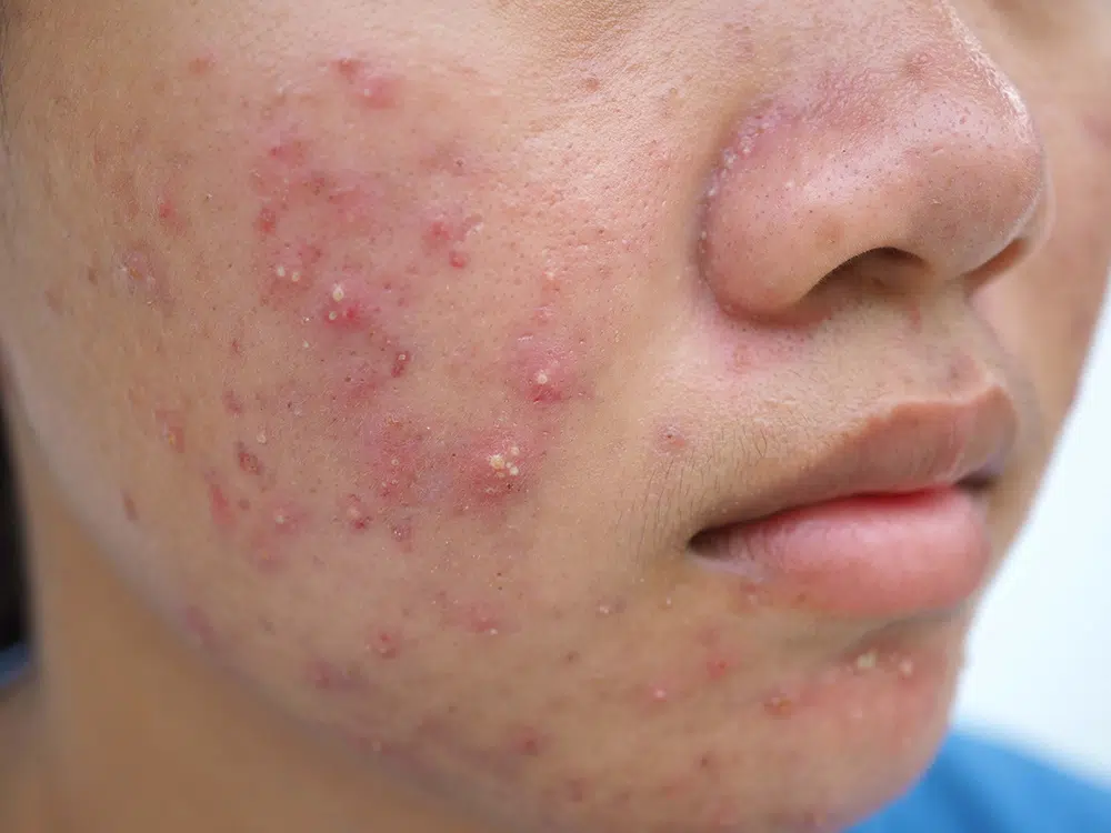 different types of acne