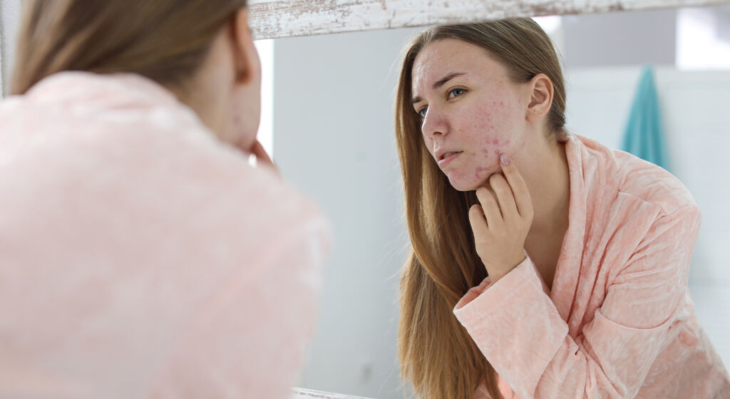 different types of acne