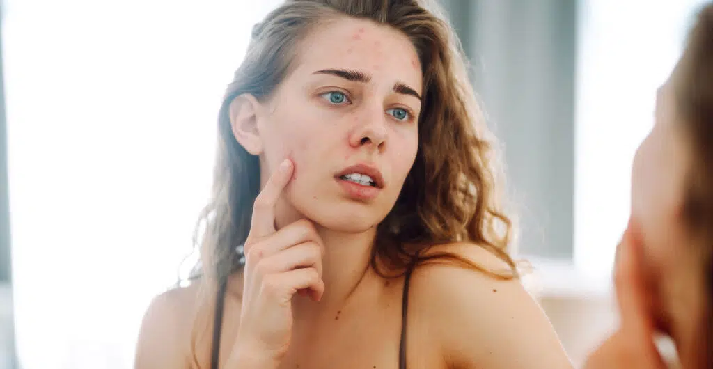 What does stress do to skin and how can you alleviate it