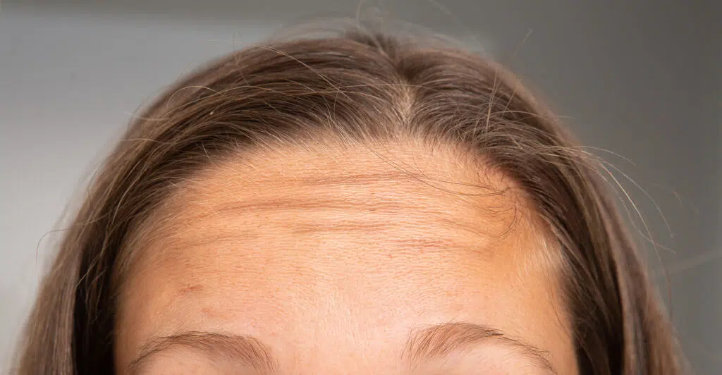 how to get rid of forehead lines