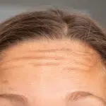 how to get rid of forehead lines