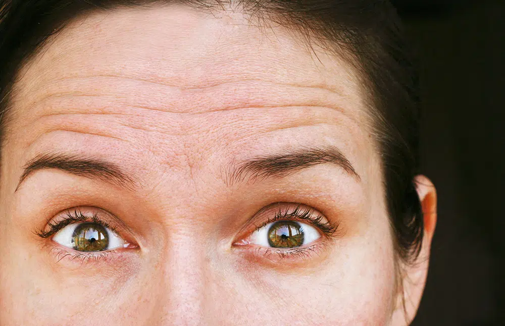 Understanding the Origins of Forehead Lines