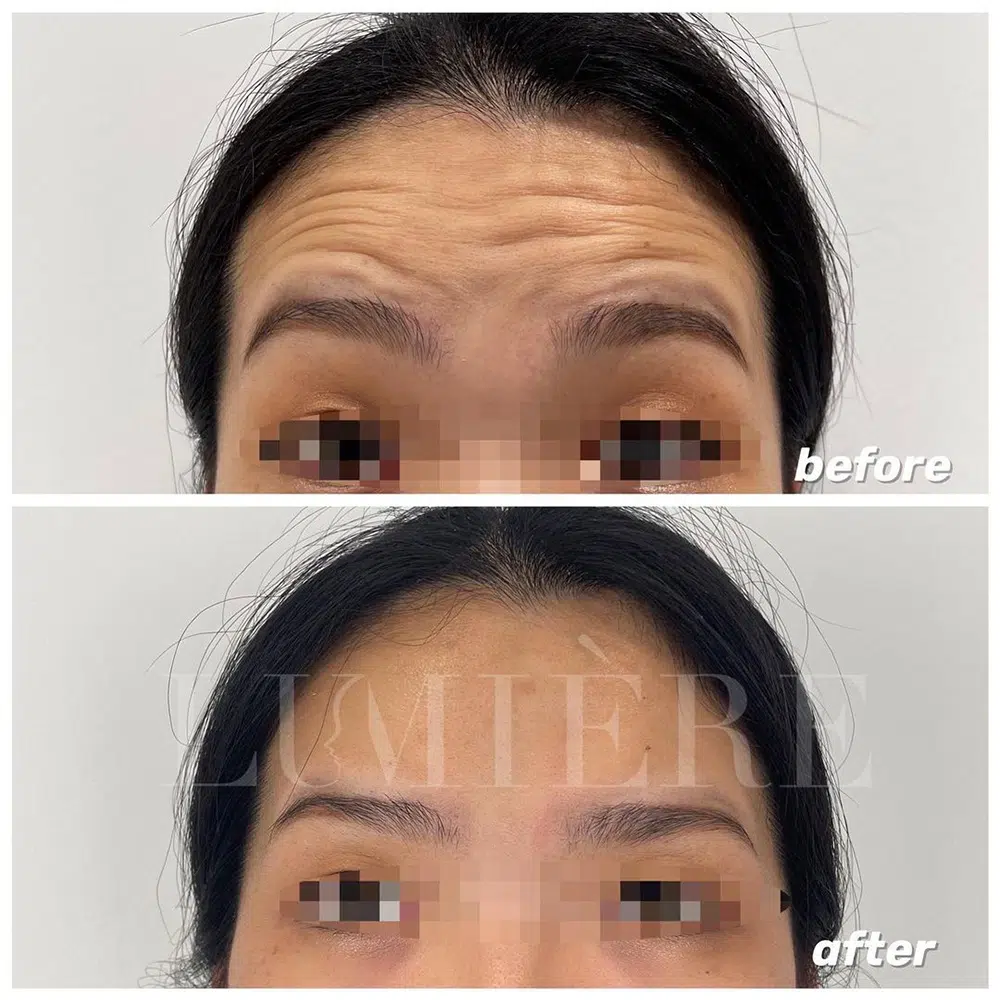 IPL skin rejuvenation for forehead lines